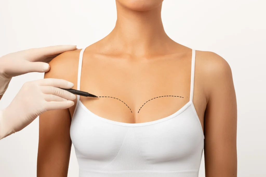 Breast Implant