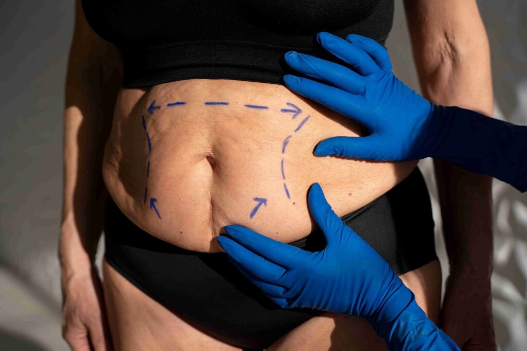 Bariatric Weight Loss Surgery