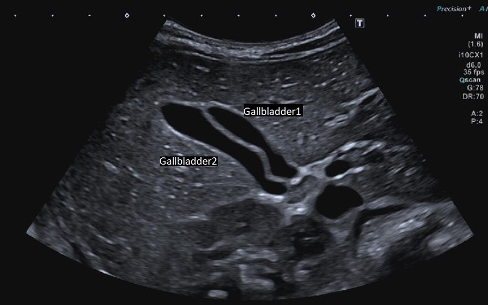 Normal Gallbladder Size