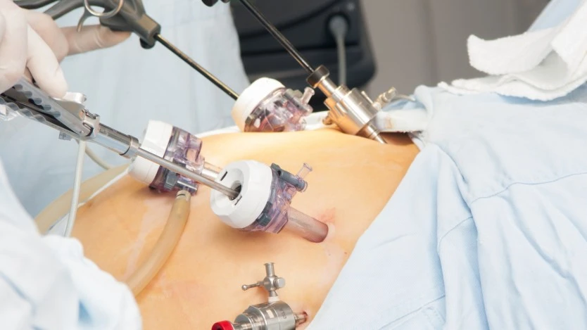 Hiatus Hernia Treatment in Hisar