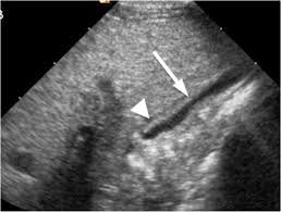 Normal Gallbladder Size