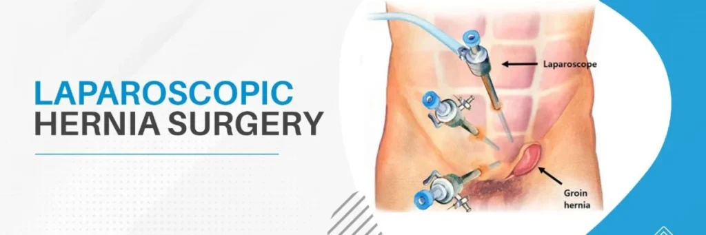 how long does laparoscopic hernia surgery take