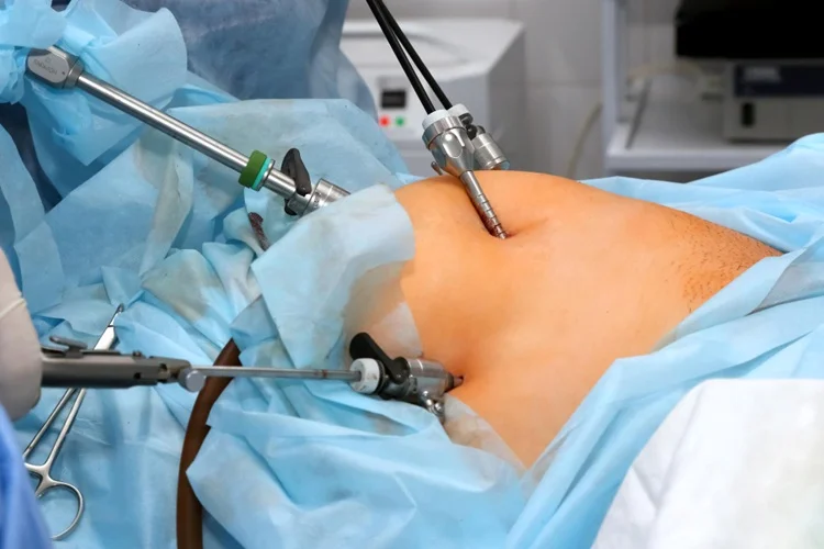 What Is Laparoscopic Hernia Surgery?