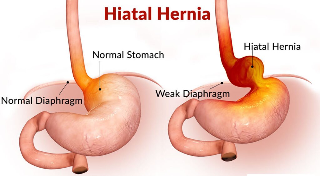 Hiatus Hernia Symptoms and Causes: When You Should See a Doctor
