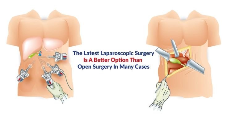 When Open Surgery Is the Better Choice
