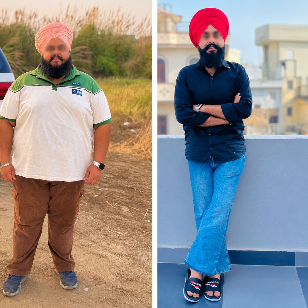 Before and after weight loss surgery result at Meyash Hospital, Hisar