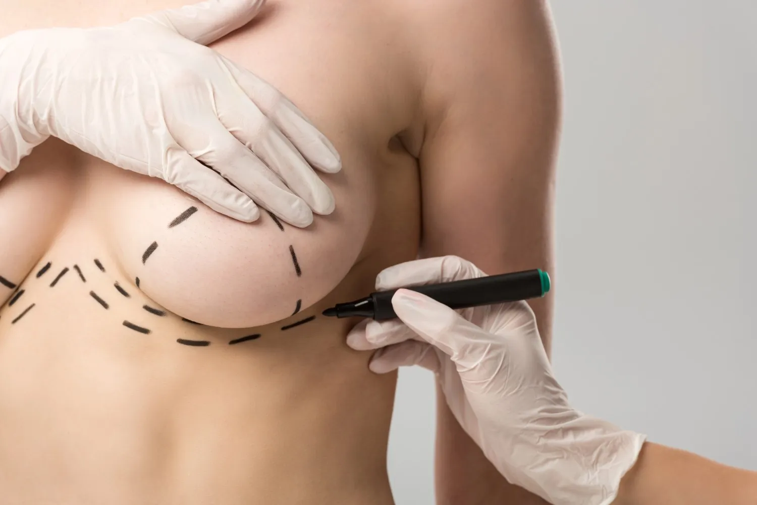 Breast Uplift Scars