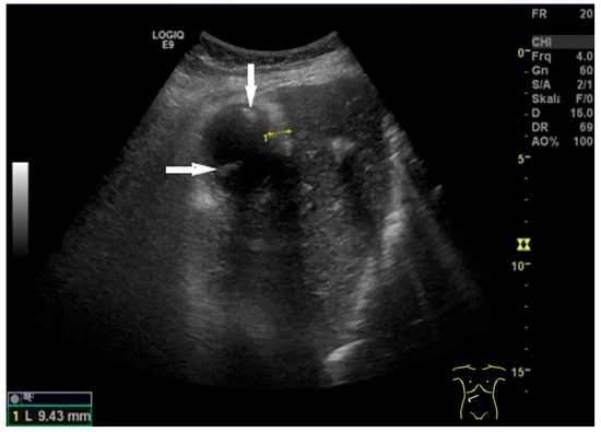 Normal Gallbladder Size