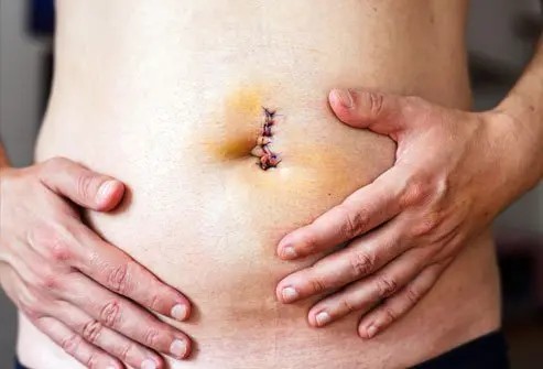 Umbilical Hernia Laparoscopic Surgery